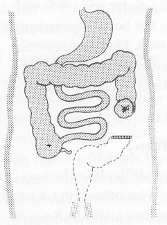 ileostomy diagram ileostomy diagram 28 images 301 moved permanently ileostomy diagram ileostomy diagram 28 images 301 moved permanently
